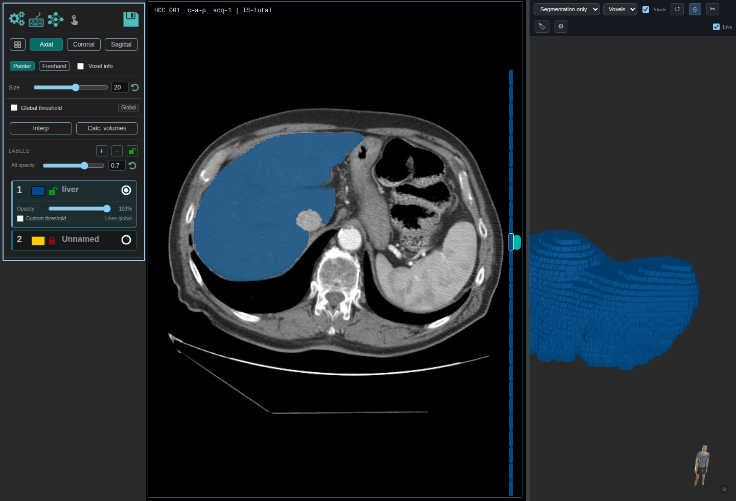 TotalSegmentator liver mask on a soft tissue CT window in MedSeg.