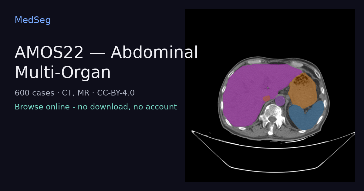 AMOS22 - Abdominal Multi-Organ - example case rendered in the MedSeg editor