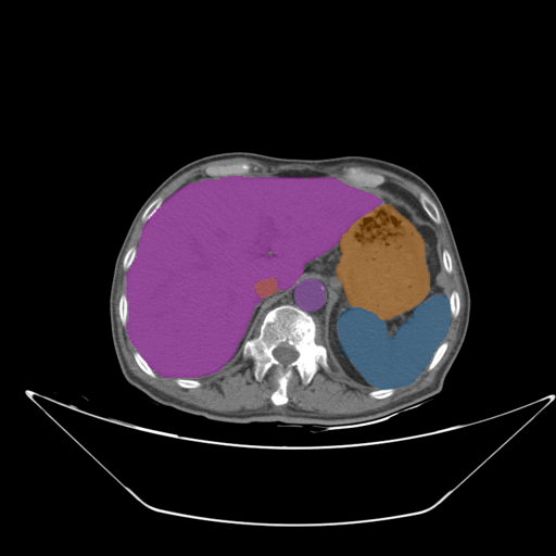 AMOS22 - Abdominal Multi-Organ preview