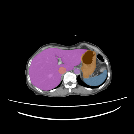 amos_0004 - AMOS22 - Abdominal Multi-Organ case preview