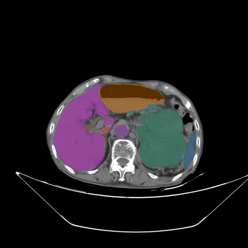 amos_0005 - AMOS22 - Abdominal Multi-Organ case preview