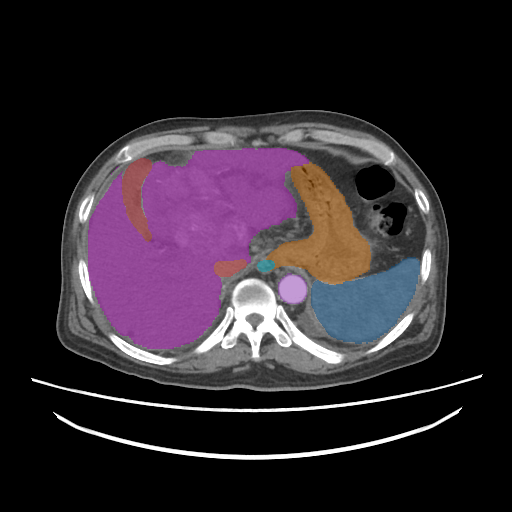amos_0006 - AMOS22 - Abdominal Multi-Organ case preview