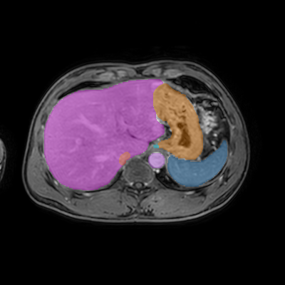 amos_0517 - AMOS22 - Abdominal Multi-Organ case preview