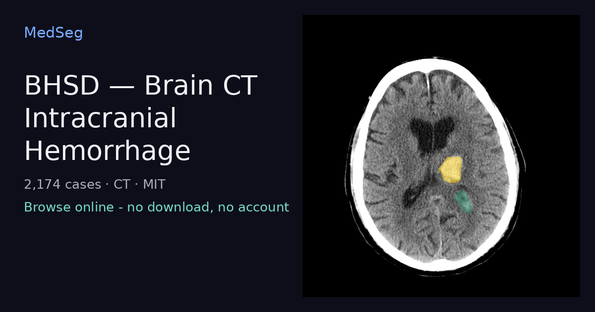 BHSD - Brain CT Intracranial Hemorrhage - example case rendered in the MedSeg editor
