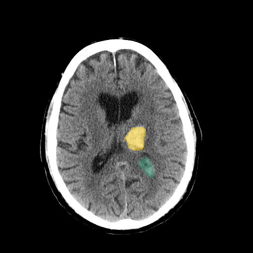 BHSD - Brain CT Intracranial Hemorrhage preview