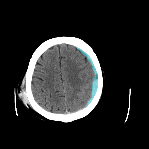 029ebbea_563afa0901 - BHSD - Brain CT Intracranial Hemorrhage case preview