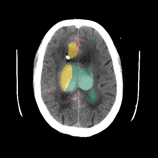 02b882cc_a4892e60ae - BHSD - Brain CT Intracranial Hemorrhage case preview