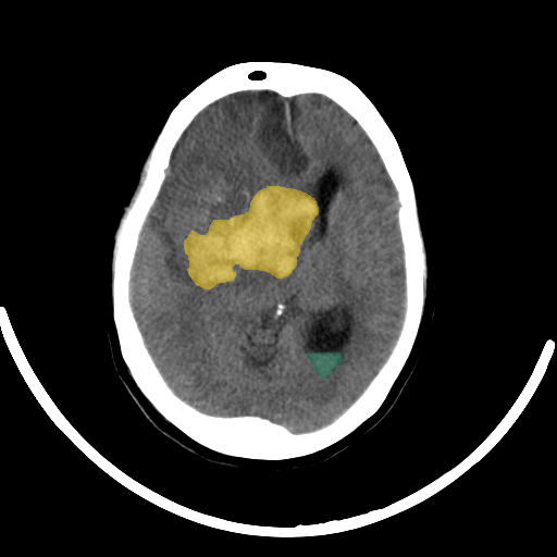 02f779fb_c4d7f33559 - BHSD - Brain CT Intracranial Hemorrhage case preview