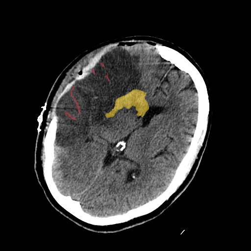 1653b22b_c35cd0de73 - BHSD - Brain CT Intracranial Hemorrhage case preview