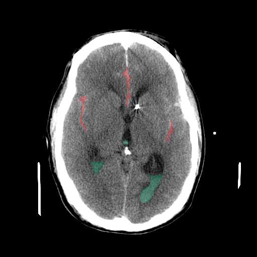 b367130b_debc60a9ba - BHSD - Brain CT Intracranial Hemorrhage case preview