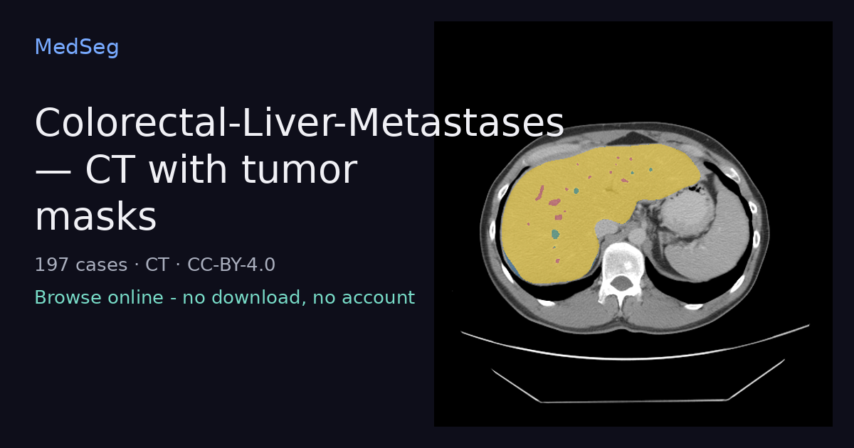 Colorectal-Liver-Metastases - CT with tumor masks - example case rendered in the MedSeg editor