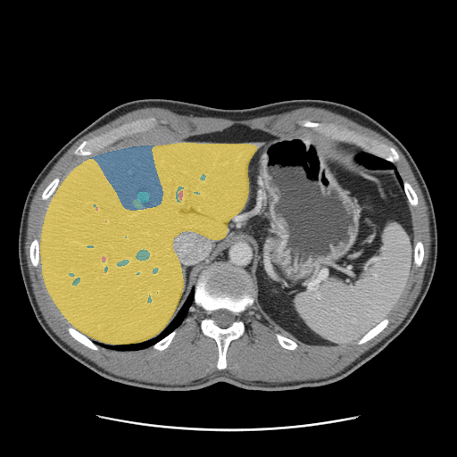 CRLM-CT-1001 - Colorectal-Liver-Metastases - CT with tumor masks case preview