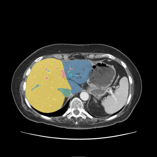 CRLM-CT-1002 - Colorectal-Liver-Metastases - CT with tumor masks case preview