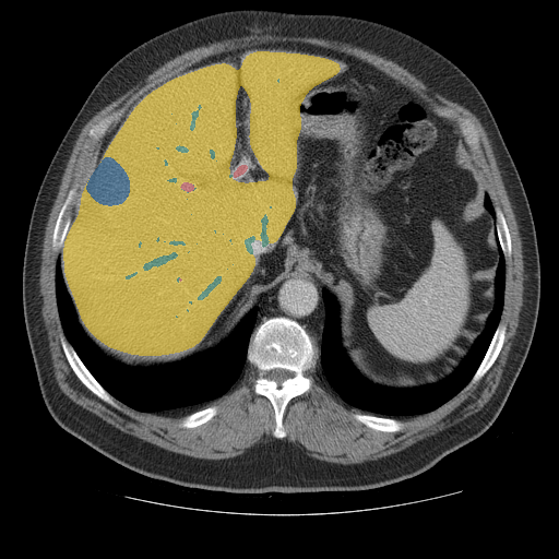 CRLM-CT-1003 - Colorectal-Liver-Metastases - CT with tumor masks case preview