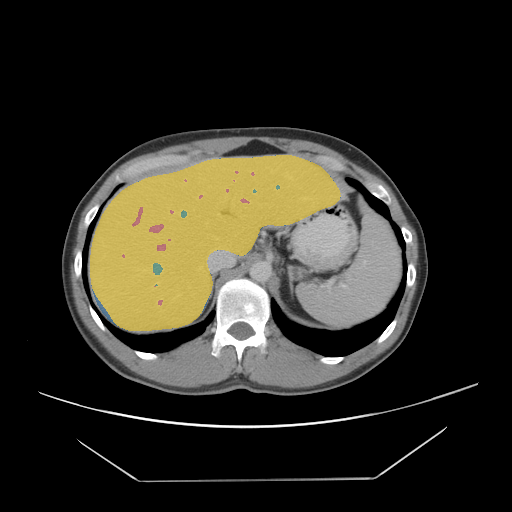 Colorectal-Liver-Metastases - CT with tumor masks preview