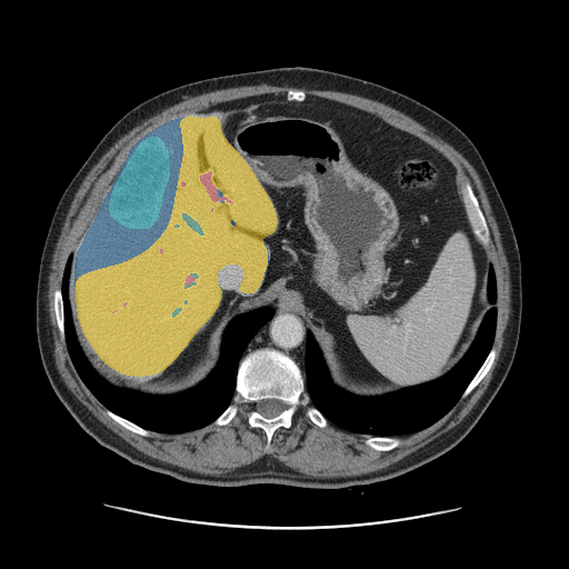 CRLM-CT-1005 - Colorectal-Liver-Metastases - CT with tumor masks case preview