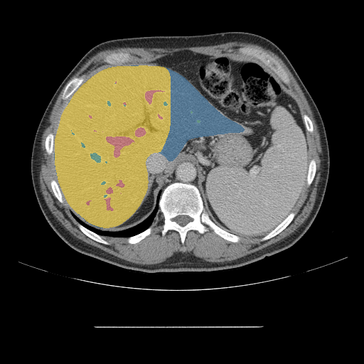 CRLM-CT-1025 - Colorectal-Liver-Metastases - CT with tumor masks case preview