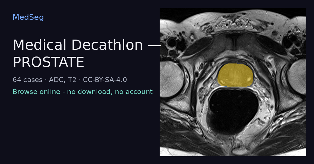 Medical Decathlon - PROSTATE - example case rendered in the MedSeg editor