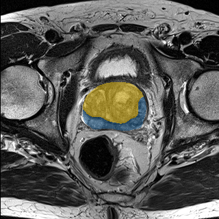 prostate_01-t2 - Medical Decathlon - PROSTATE case preview