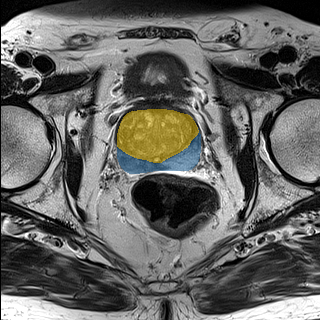 prostate_02-t2 - Medical Decathlon - PROSTATE case preview