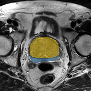 prostate_04-t2 - Medical Decathlon - PROSTATE case preview