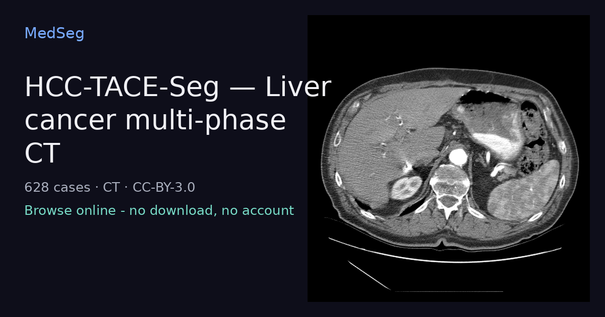 HCC-TACE-Seg - Liver cancer multi-phase CT - example case rendered in the MedSeg editor