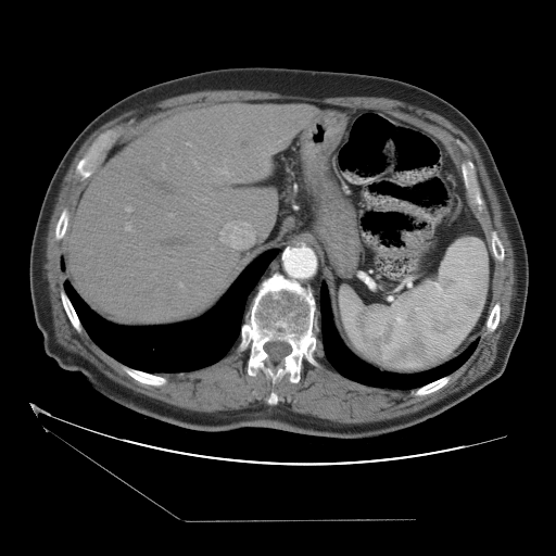 HCC_001__c-a-p__acq-1 - HCC-TACE-Seg - Liver cancer multi-phase CT case preview