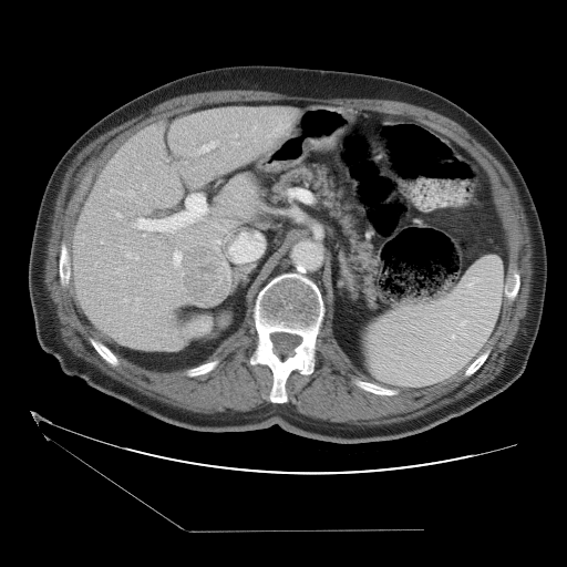 HCC_001__c-a-p__acq-2 - HCC-TACE-Seg - Liver cancer multi-phase CT case preview
