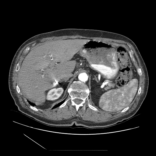 HCC-TACE-Seg - Liver cancer multi-phase CT preview