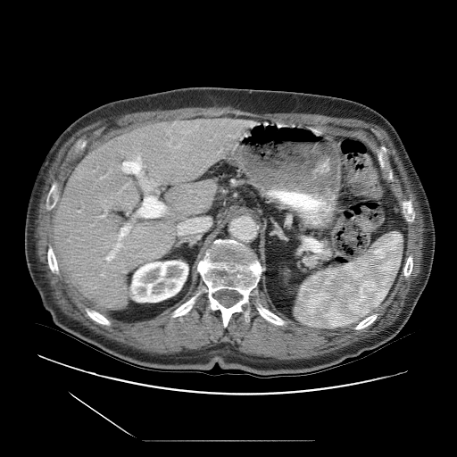 HCC_001__series__uid-b73326c6 - HCC-TACE-Seg - Liver cancer multi-phase CT case preview