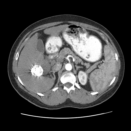 HCC_010__recon-2-liver-3-phase-ap__uid-be0a5421 - HCC-TACE-Seg - Liver cancer multi-phase CT case preview