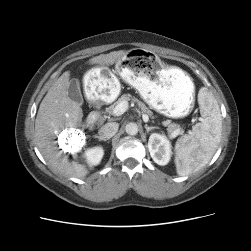 HCC_010__recon-3-liver-3-phase-ap - HCC-TACE-Seg - Liver cancer multi-phase CT case preview