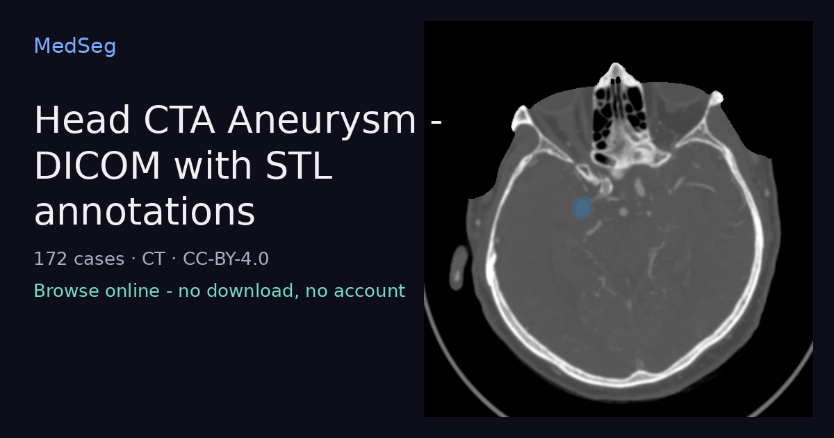 Head CTA Aneurysm - DICOM with STL annotations - example case rendered in the MedSeg editor