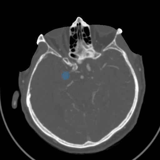 Head CTA Aneurysm - DICOM with STL annotations preview
