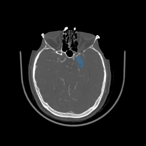004 - Head CTA Aneurysm - DICOM with STL annotations case preview