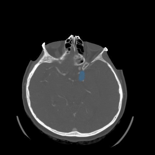 006 - Head CTA Aneurysm - DICOM with STL annotations case preview