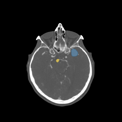 008 - Head CTA Aneurysm - DICOM with STL annotations case preview