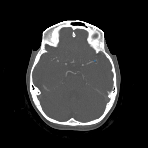 010 - Head CTA Aneurysm - DICOM with STL annotations case preview