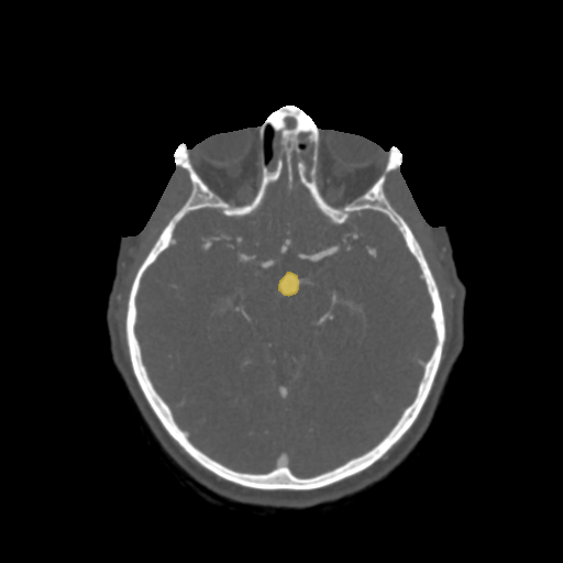033 - Head CTA Aneurysm - DICOM with STL annotations case preview