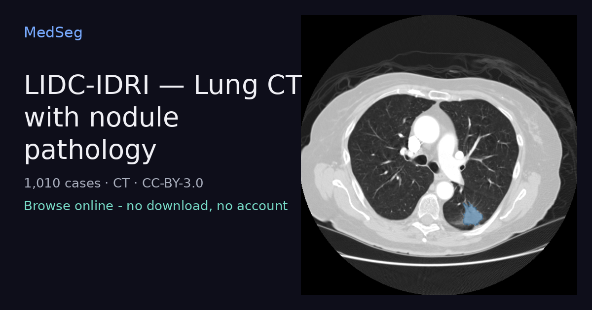 LIDC-IDRI - Lung CT with nodule pathology - example case rendered in the MedSeg editor