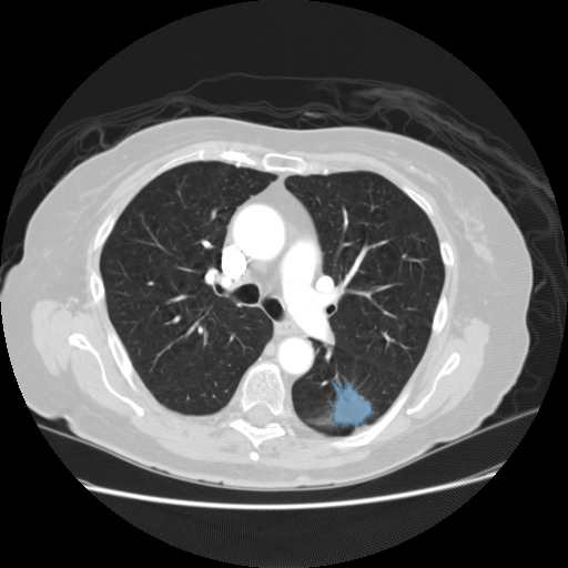 LIDC-IDRI - Lung CT with nodule pathology preview