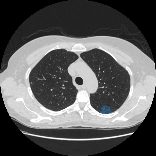 LIDC-IDRI-0002 - LIDC-IDRI - Lung CT with nodule pathology case preview
