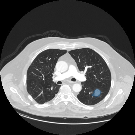 LIDC-IDRI-0003 - LIDC-IDRI - Lung CT with nodule pathology case preview