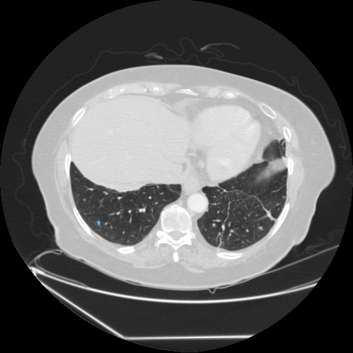 LIDC-IDRI-0004 - LIDC-IDRI - Lung CT with nodule pathology case preview