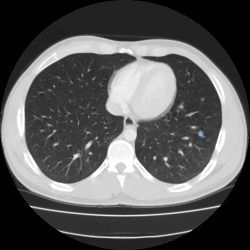 LIDC-IDRI lung CT preview from the MedSeg public dataset catalog.