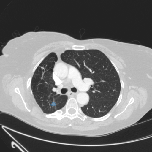 LIDC-IDRI-0888 - LIDC-IDRI - Lung CT with nodule pathology case preview