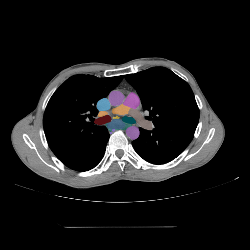 esophageal-cancer - MedSeg Anatomy Atlas case preview