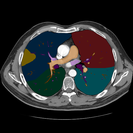 lung-lobes-vessels-airways - MedSeg Anatomy Atlas case preview