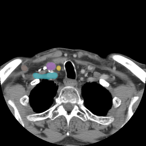 vasculature-of-the-neck - MedSeg Anatomy Atlas case preview