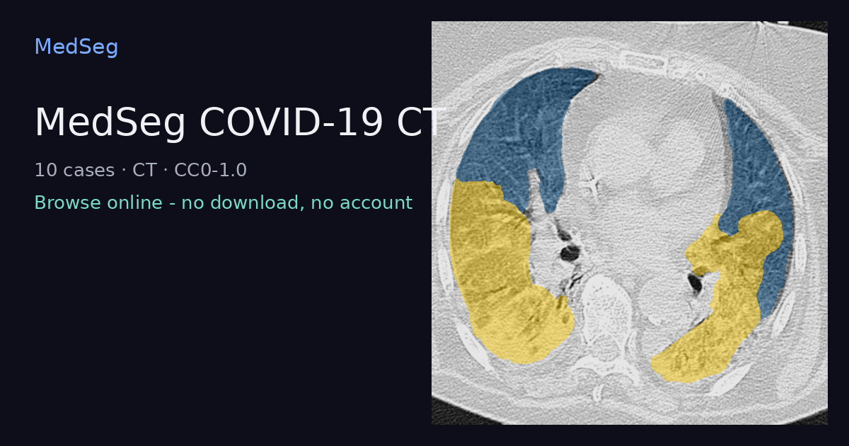 MedSeg COVID-19 CT - example case rendered in the MedSeg editor
